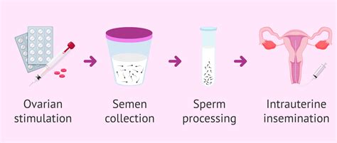 artificial insemination porn|Artificial Insemination Putting Cum in Cervix .